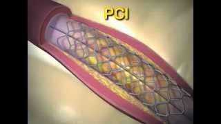 Trial of Everolimus Eluting Stents or Bypass Surgery for Coronary Disease [upl. by Etra]