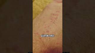 Dermatitis Herpetiformis Relief [upl. by Ramirol958]