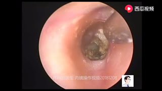 Postoperative review of external auditory canal cholesteatoma and middle ear cholesteatoma [upl. by Hocker]