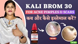 Magical Remedy For Acne Pimples and Scars  kali Brom 30  कब और कैसे इस्तेमाल करें  Dr Arwa Bohra [upl. by Toby]