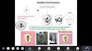 Endodontics  access cavity preparation misarah video [upl. by Tnecillim]