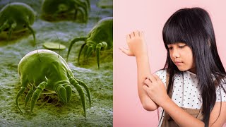 How To Get Rid of Scabies  Causes amp Remedies [upl. by Merdith]