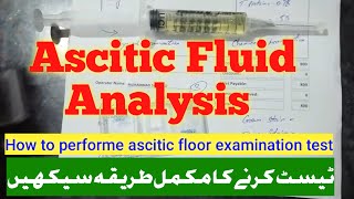 Ascitic Fluid Examination TestAscitic fluid analysisascitic fluid [upl. by Nyleuqcaj]