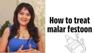 Best ways to treat Malar Festoon  Dr Shuba Dharamana  Dermatologist  Lejeune Medspa [upl. by Eledoya]