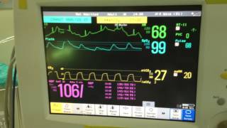 Desflurane in LMA anesthesia Maintenance 2 [upl. by Meingoldas]