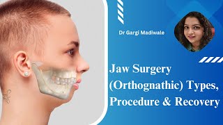 Jaw Surgery Orthognathic Types Procedure amp Recovery  Patient education I MIC [upl. by Ogires277]