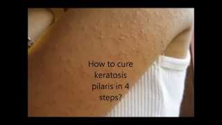 How to cure keratosis pilaris in 4 easy steps [upl. by Cumings]