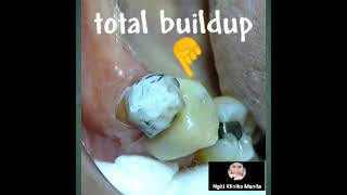 splint under cosmetic total buildup premolar tooth mobile amp deep caried enamel shell almost ruined [upl. by Enyehc312]