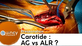 ALR ou AG pour la chirurgie carotidienne [upl. by Dugald]