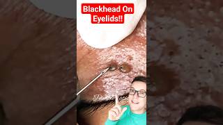 Crazy EYELID BLACKHEAD REMOVAL  This Is Extreme shorts [upl. by Trixy498]