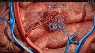 3D Medical Animation HD  Arteriovenous Malformation Brain AVM [upl. by Helsa]