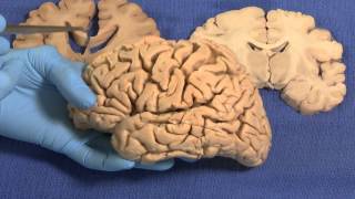 Limbic Neuroanatomy Video Lab  Brain Dissections [upl. by Nolram]