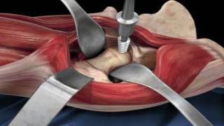 Direct Anterior Approach Hip Replacement [upl. by Elane397]