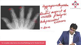 Hyperparathyroidism  Radiology [upl. by Colfin]