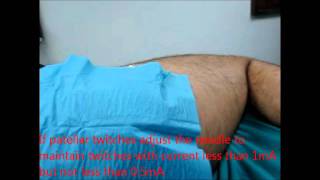 posterior lumbar plexus block nerve stimulationwmv [upl. by Reivax]