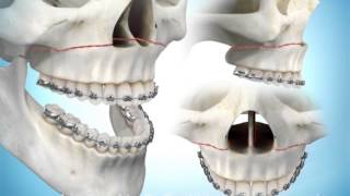 Maxillary Advancement Surgery [upl. by Cummine859]