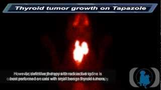 Thyroid Tumor Growth on Tapazole [upl. by Soo]