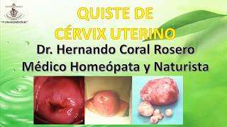 QUISTE DE CÉRVIX UTERINO  TUMOR LLENO DE MOCO EN LA SUPERFICIE DEL CUELLO DEL ÚTERO [upl. by Edlitam]