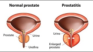 Prostatitis [upl. by Barrow]