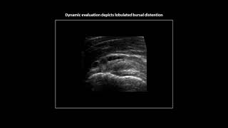 Lobulated subacromialsubdeltoid bursitis on shoulder ultrasound [upl. by Almond]