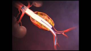 Aneurisma da Aorta Abdominal  AAA  Cirurgia Endovascular [upl. by Byran]