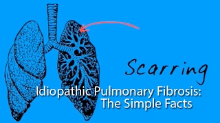 Idiopathic Pulmonary Fibrosis The Simple Facts [upl. by Keyes]