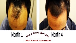 Homeopathic Medicine For Alopecia and Baldness  Hair Care Bangla [upl. by Nnorahs]