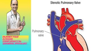 PULMPNARY STENOSIS VALVE BY DRSUMIT TYAGISUMITMEDICALDISPENSARY1 [upl. by Netsirc617]