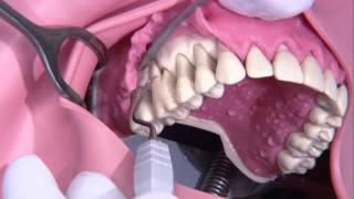 Periodontal surgery Modified Widmann flap [upl. by Stempson]