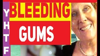 Gum Receding Gums Natural Help [upl. by Welsh192]