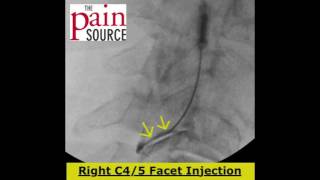 Cervical Facet Injection under fluoroscopy  ThePainSourcecom [upl. by Sileas]