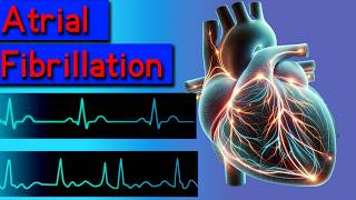 Atrial fibrillation symptoms causes risks and treatment [upl. by Sheya]