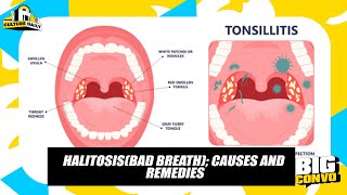 Halitosis Causes Effects And It’s Treatment [upl. by Eecrad]