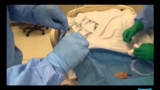 Percutaneous Endoscopic Gastrostomy pull method and Jejunal Extension Tube Placement [upl. by Durkin207]