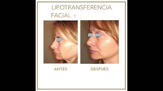 Antes y después de lipotransferencia facial y minilifting  Instituto Dra Ana Torres Barcelona [upl. by Nahgeem232]