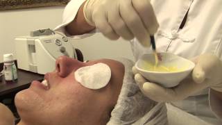 Fruchtsäurepeeling und Mikrodermabrasion [upl. by Frendel]