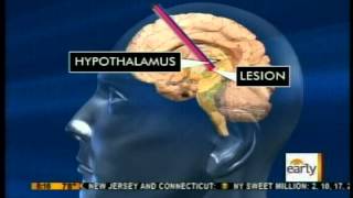 Breakthrough in Epilepsy Treatment at Texas Childrens Hospital  CBS The Early Show [upl. by Hinman]