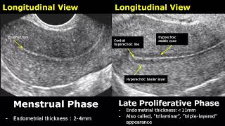 Endometrial Thickness Ultrasound Image Appearances  Endometrium Menstrual Cycle USG Images [upl. by Swithbert429]