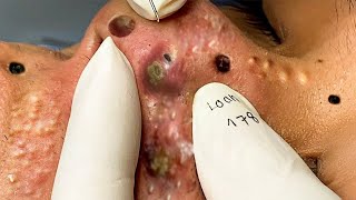 Big Cystic Acne Blackheads Extraction Blackheads amp Milia Whiteheads Removal Pimple Popping  8987 [upl. by Eninaej608]