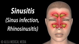 Sinusitis Animation [upl. by Uzzi]