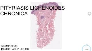 Pityriasis Lichenoides Chronica Dermpath Made Easy [upl. by Enelyam]