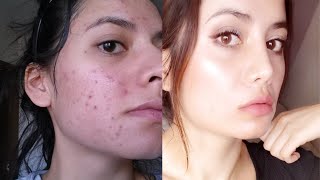 Tretinoin Before and After 12 Tips To Get The BEST RESULTS [upl. by Wise]