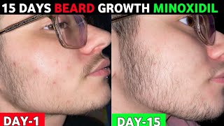 15 days beard growth minoxidil journey  minoxidil beard  mintop minoxidil review beard growth [upl. by Calli]