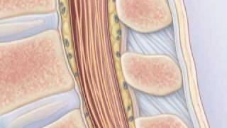 Comment pratiquer une ponction lombaire [upl. by Atsyrt637]