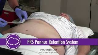 TZ Medical Pannus Retention System Application [upl. by Nnire]