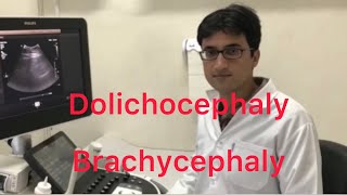 Sonography Dolichocephaly and Brachycephaly [upl. by Aimej95]