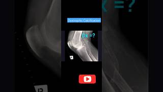 Calcification In TissueDystrophicCalcificationpathologicalcalcificationpostinjurycalcification [upl. by Cassella472]