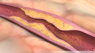 What is Atherosclerosis [upl. by Colier]