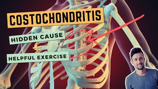 Costochondritis The Hidden Cause and a Simple Exercise to Fix Anterior Rib Joint Pain [upl. by Ehlke971]