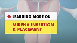 ✅ Mirena Insertion and Placement [upl. by Forsta]